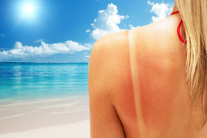 skin-cancer-sunburn-sunscreen-us-general-surgeon-warning